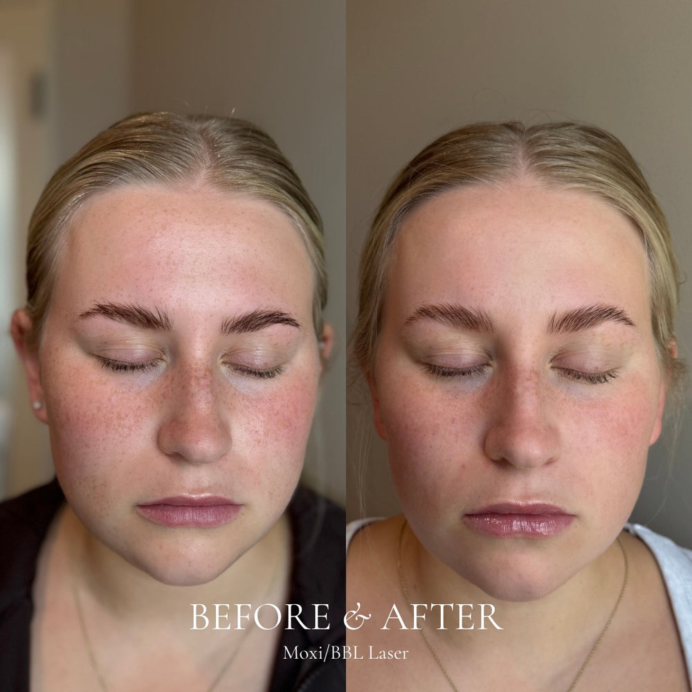 Before and after comparison of a woman's face with text indicating a cosmetic procedure.