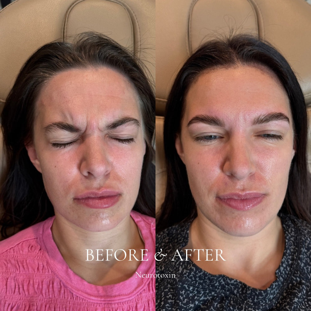 Before and after comparison of a woman's face with 'Neurotoxin' treatment.