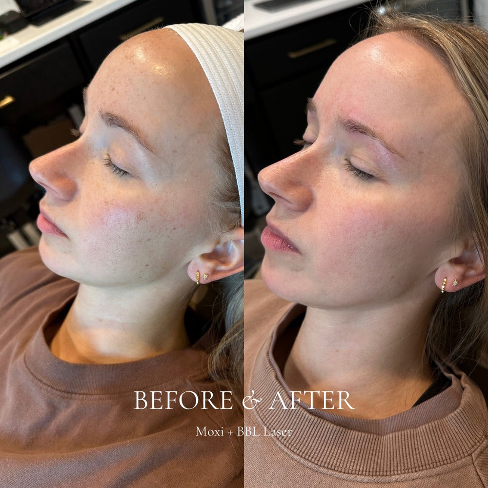 Before and after comparison of a woman's face with 'Moxi BBL Laser' text.