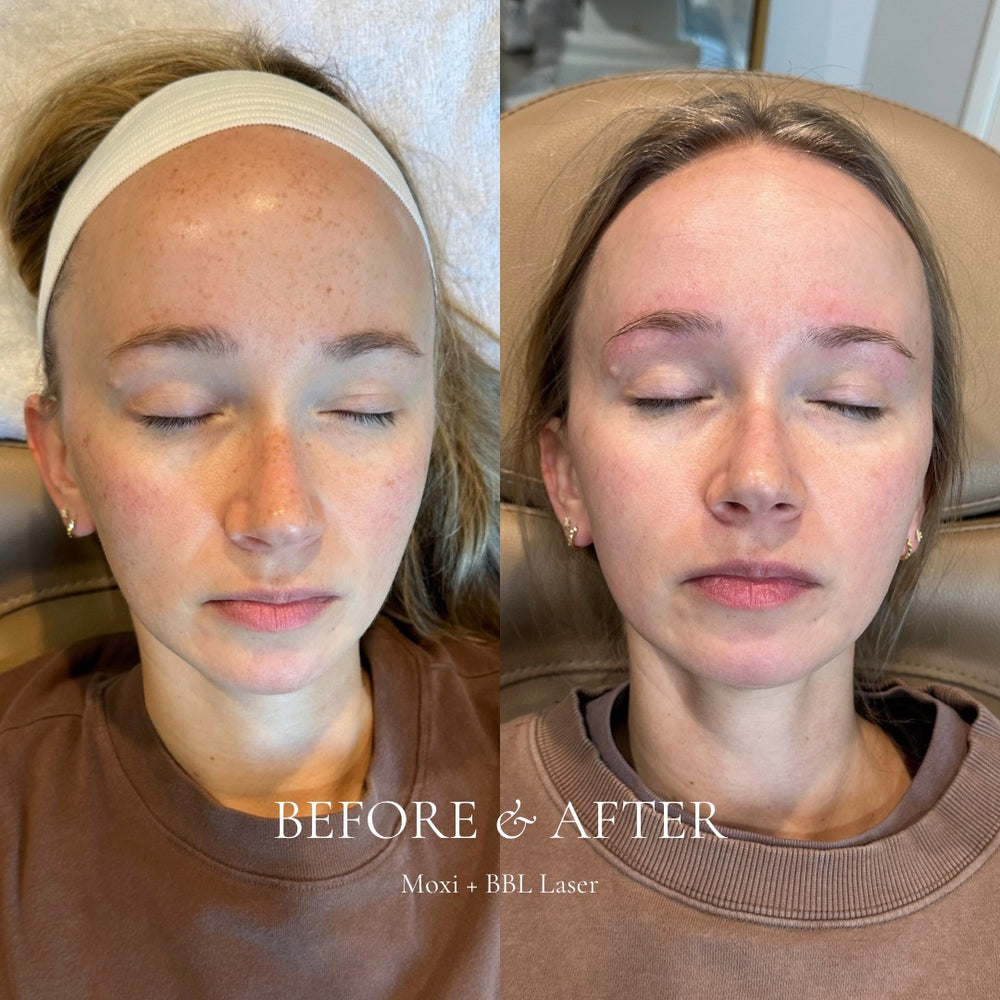 Before and after comparison of a woman's face with text indicating BBL Laser treatment.