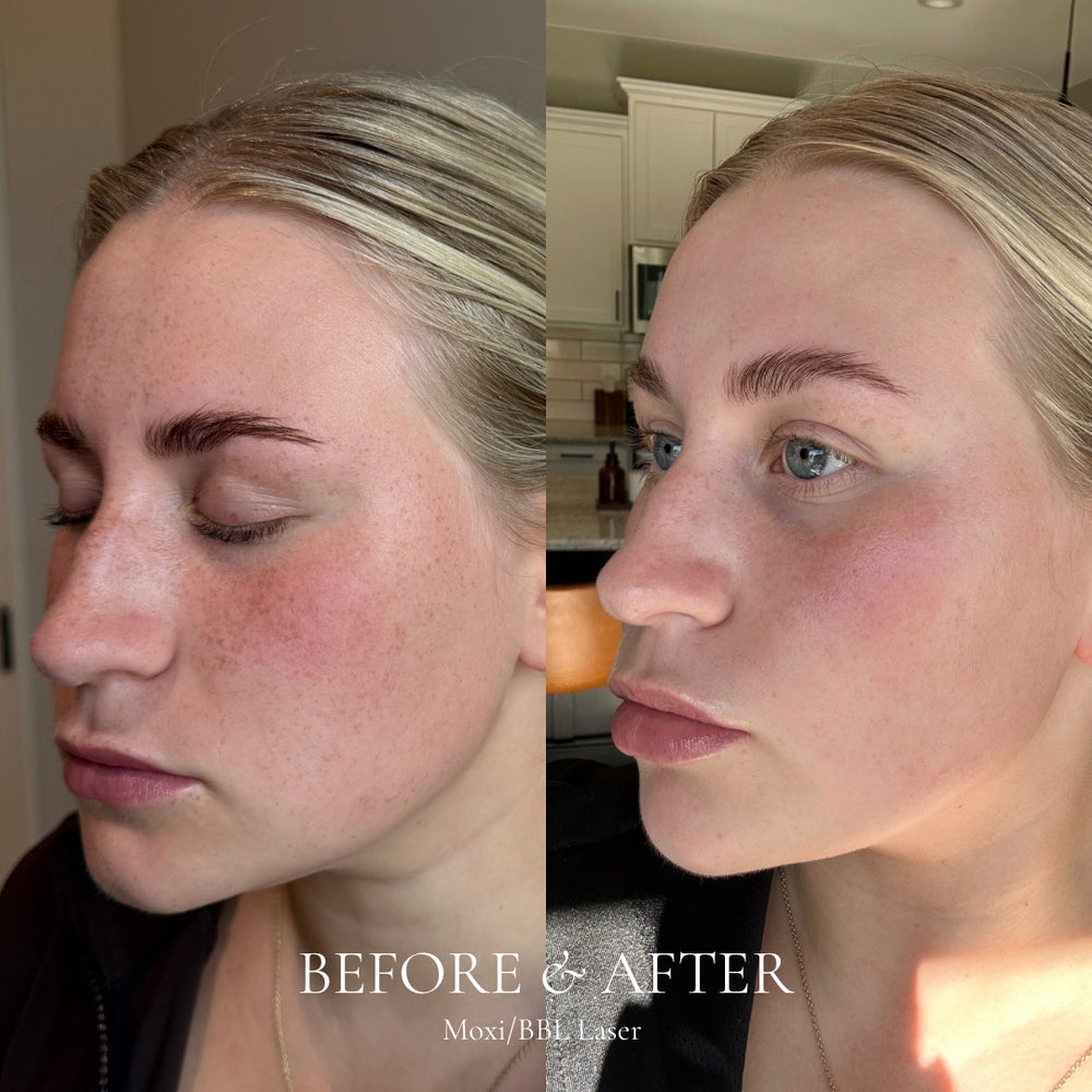 Before and after comparison of a woman's face with text 'Before & After' and 'Mosi/BBL Laser'.