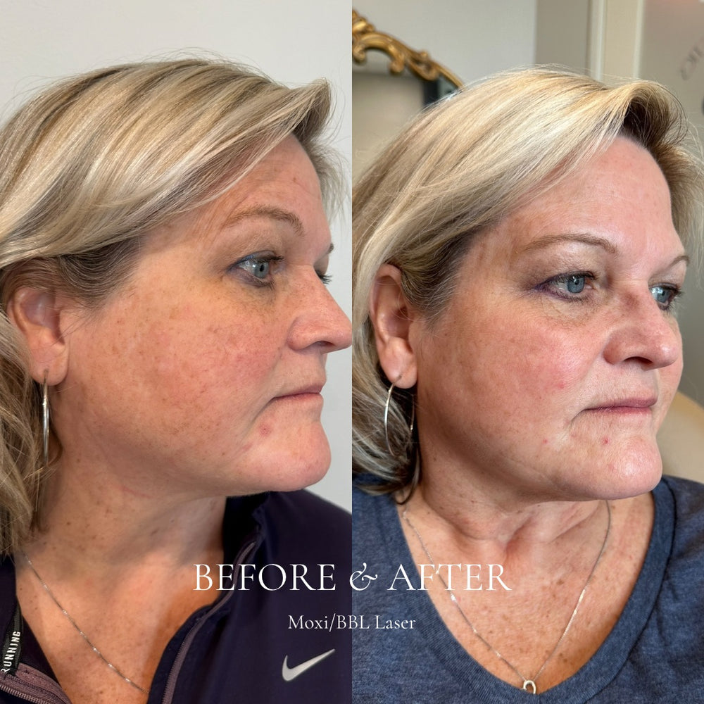 Before and after comparison of a woman's face with text indicating cosmetic treatment.