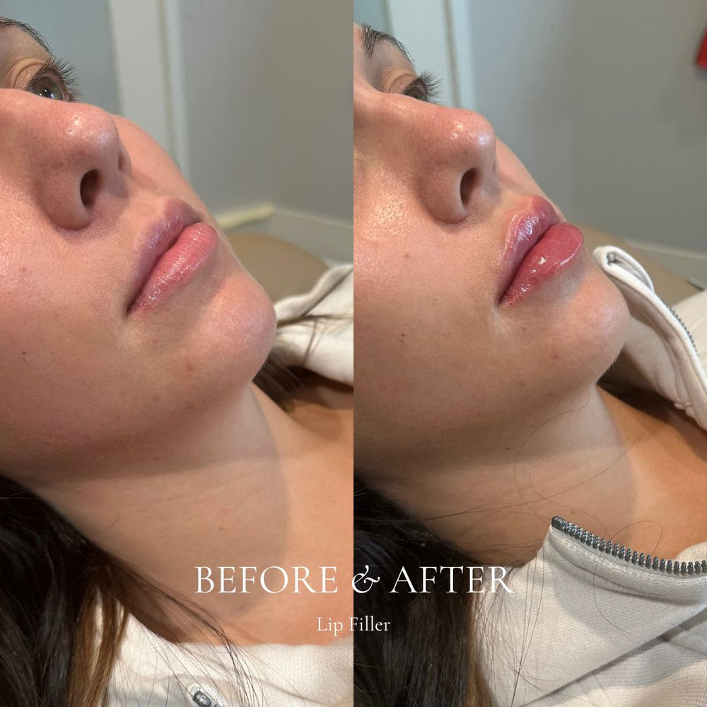 Before and after comparison of lip filler treatment on a person's face.