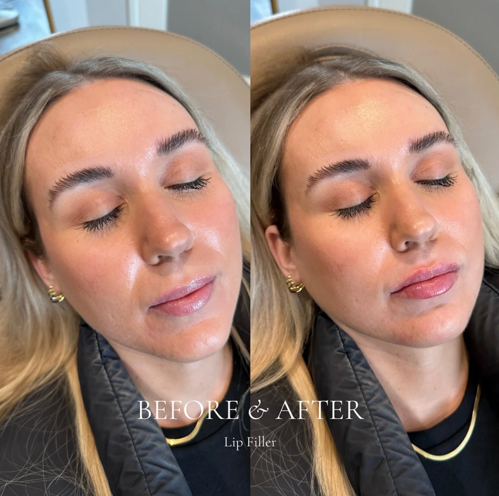 Before and after comparison of a woman with lip filler, showing close-up views of her face.