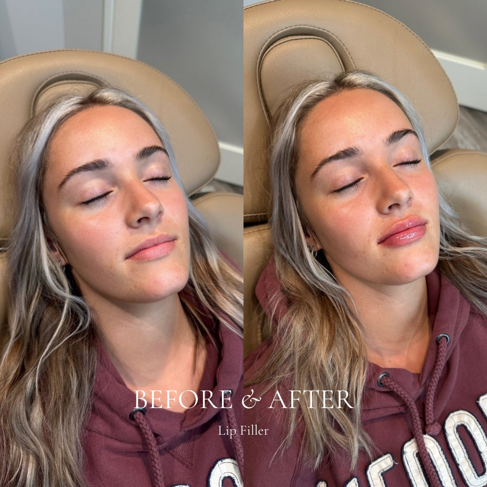 Before and after comparison of a woman with lip filler, seated in a vehicle.