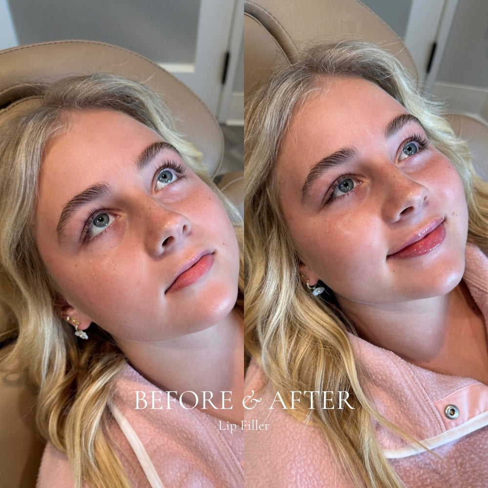 Before and after comparison of a woman with text 'Before & After Lip Filler'.
